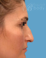 Rhinoplasty