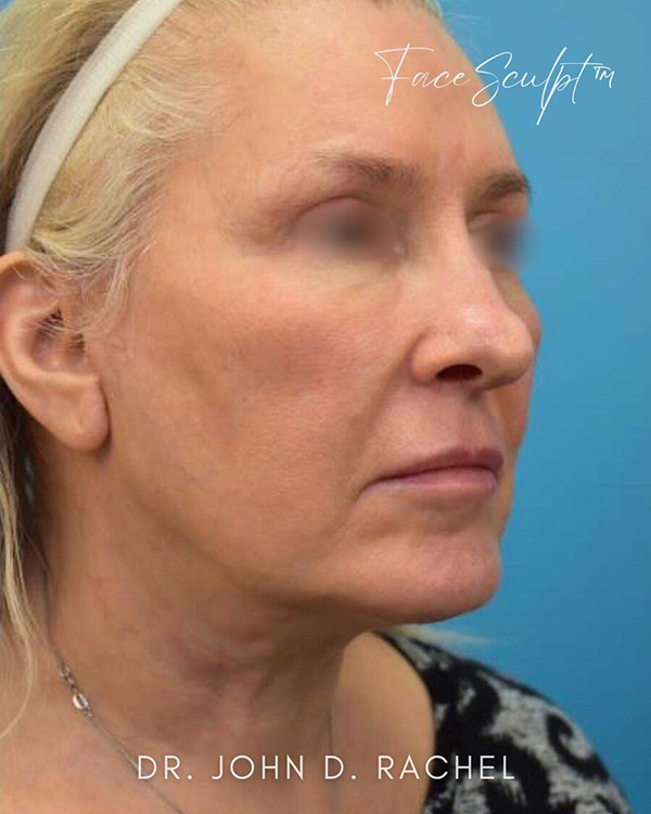 Angled view before mini facelift procedure
