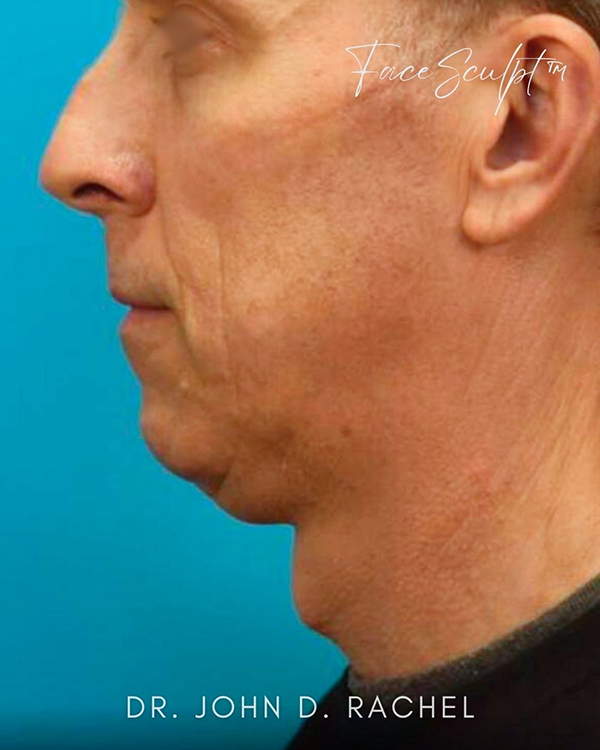 Neck Lift