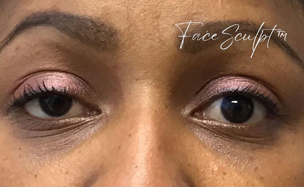 Angled view before upper eyelid surgery