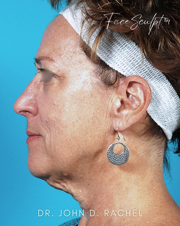 Angled view of a patient before a mini facelift procedure