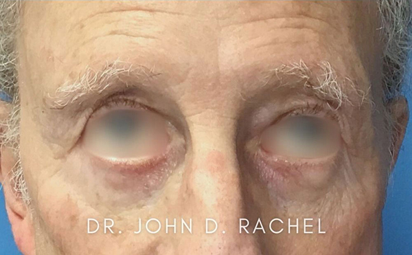 Close-up after eyelid surgery, frontal view