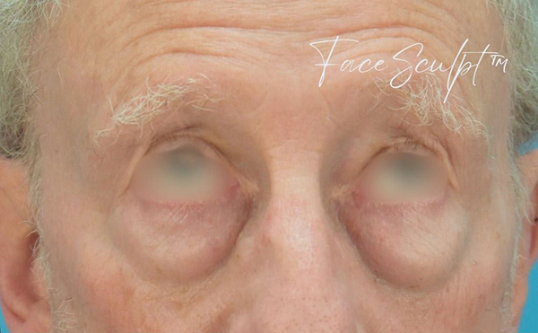 Close-up before eyelid surgery, frontal view