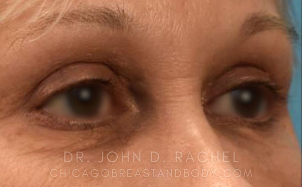 Eyelid Surgery