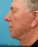 Neck Lift