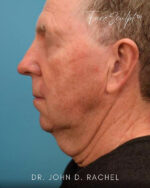 Neck Lift
