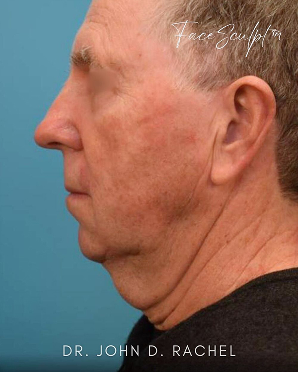 Neck Lift