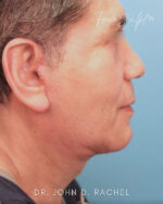 Neck Lift