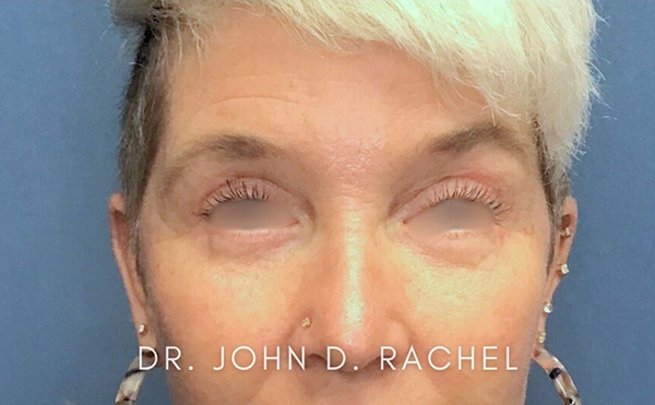 Patient After Eyelid Surgery – Frontal View Close-up view of patient after upper eyelid surgery