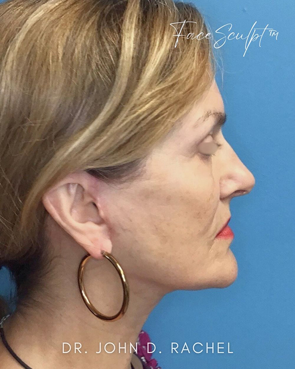 Female patient after facelift, side profile