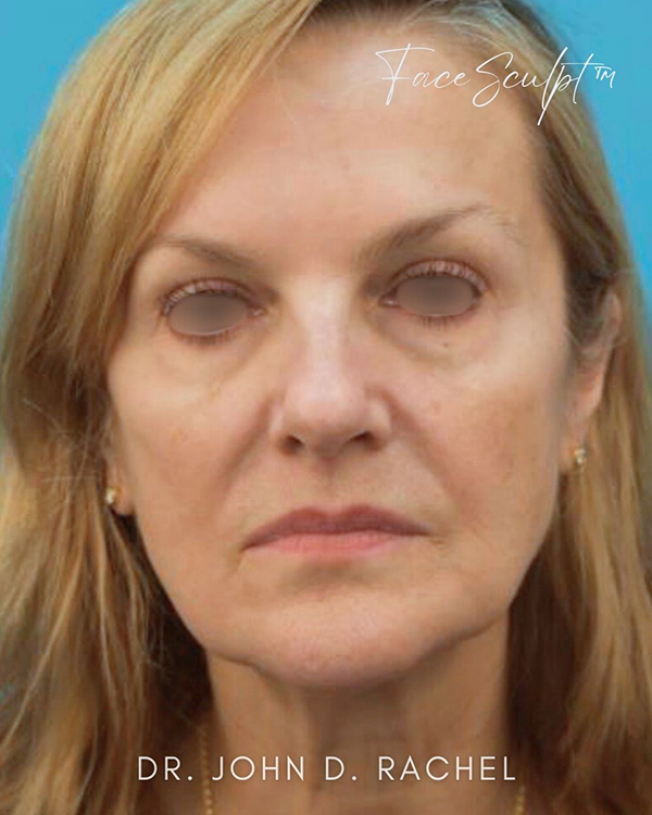 Facelift before photo – front view Female patient before facelift, front view