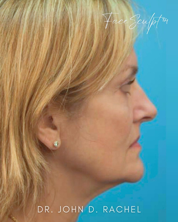 Female patient before facelift, side profile
