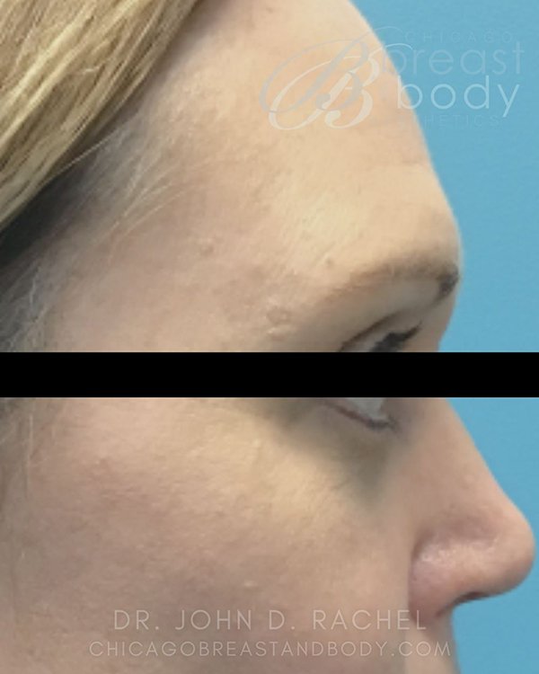 Side profile after eyelid surgery