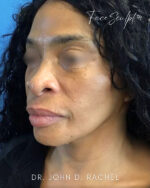 Neck Lift