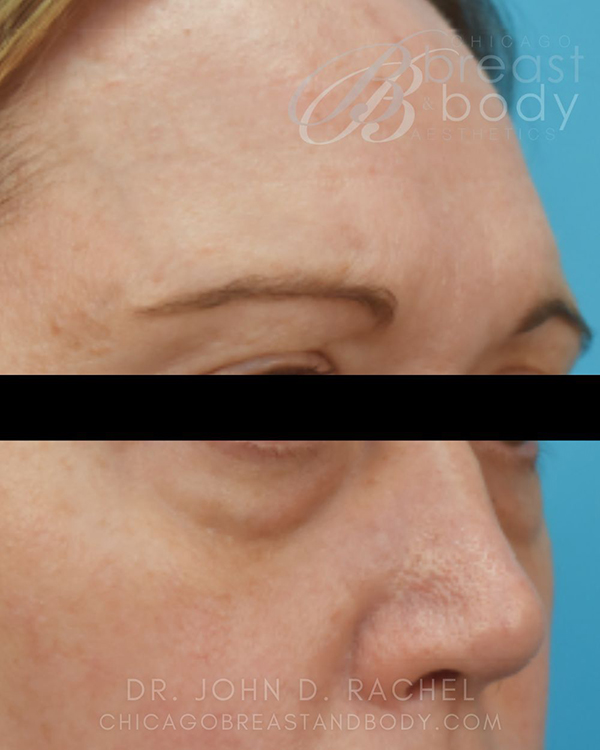 Side profile before eyelid surgery