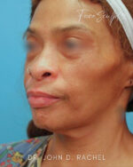Neck Lift