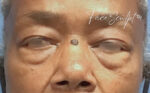 Eyelid Surgery