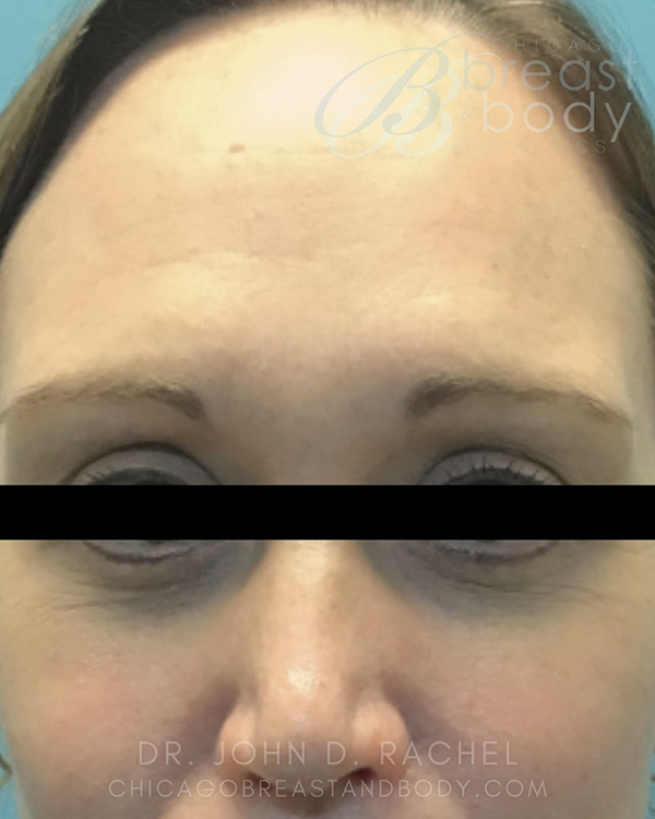 Frontal view post-upper eyelid surgery