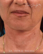 Neck Lift