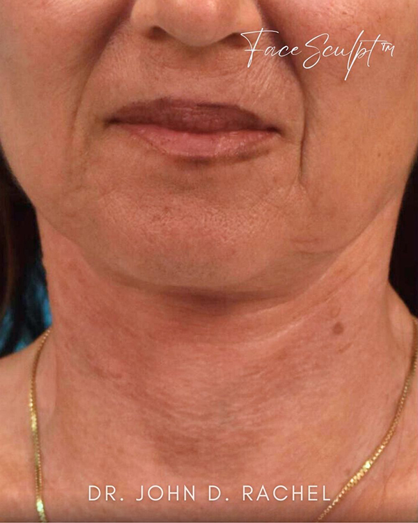 Neck Lift