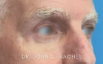 Eyelid Surgery