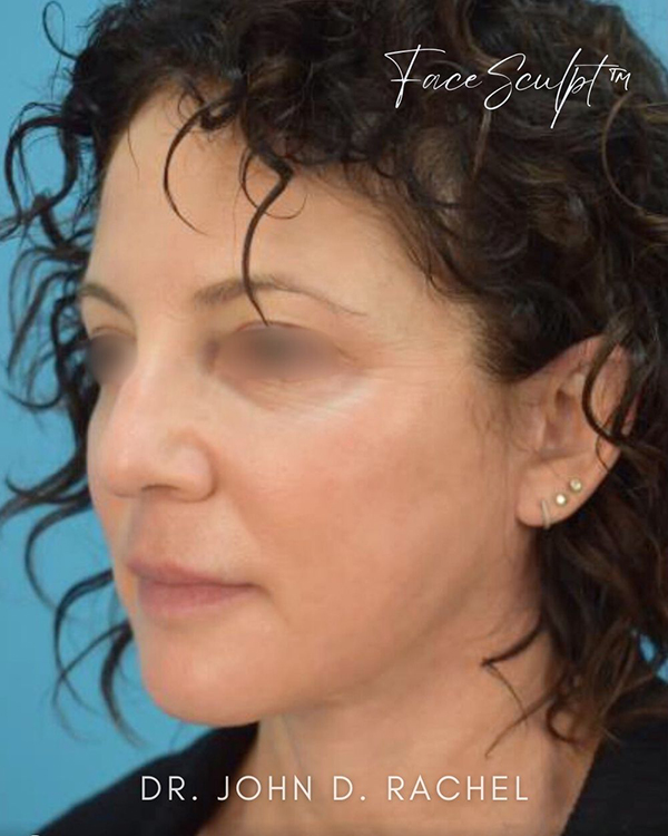 Side view of patient after undergoing a mini facelift cosmetic surgery