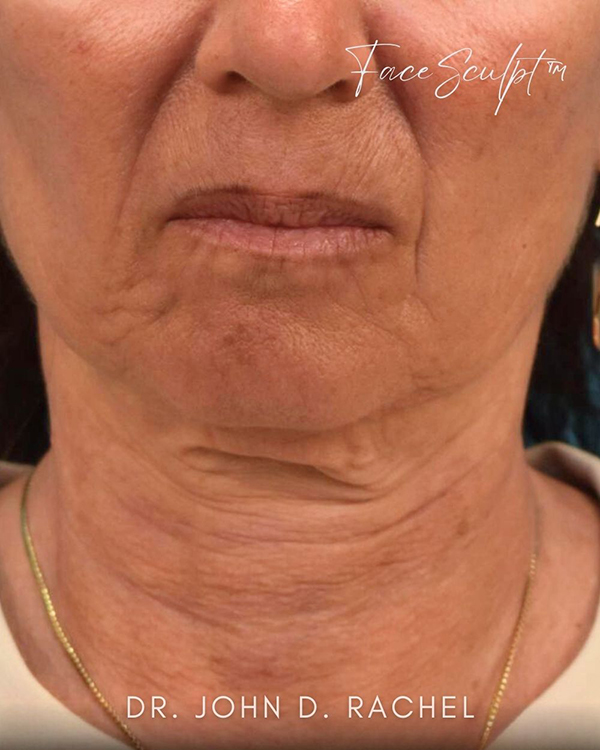 Neck Lift