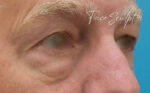 Eyelid Surgery