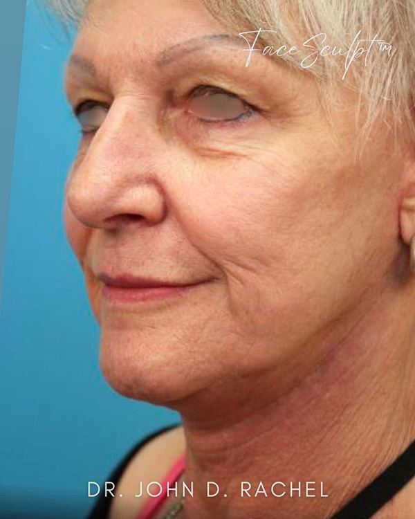 Profile view after facelift surgery transformation
