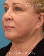 Neck Lift