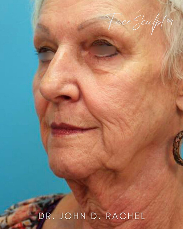 Profile view before facelift surgery transformation