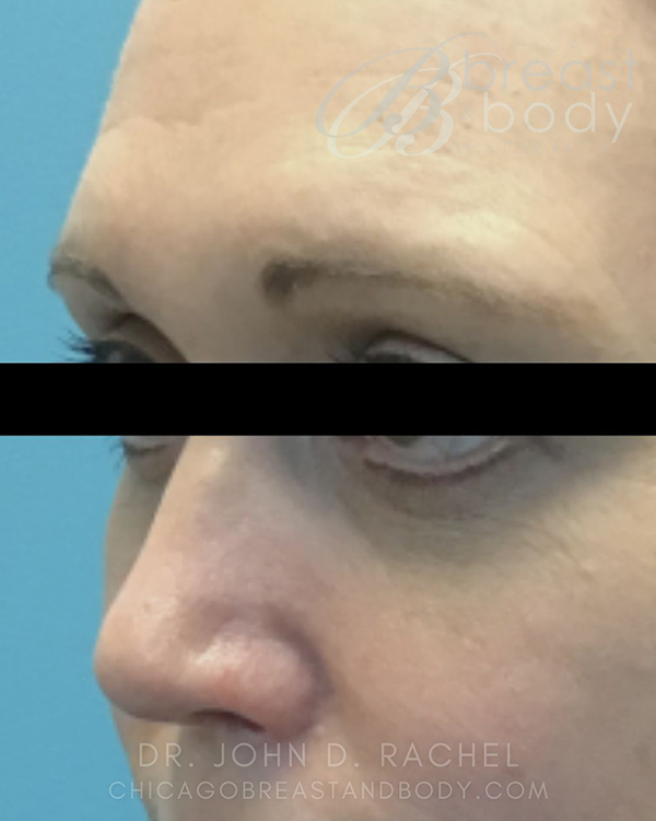 Front view after lower eyelid surgery