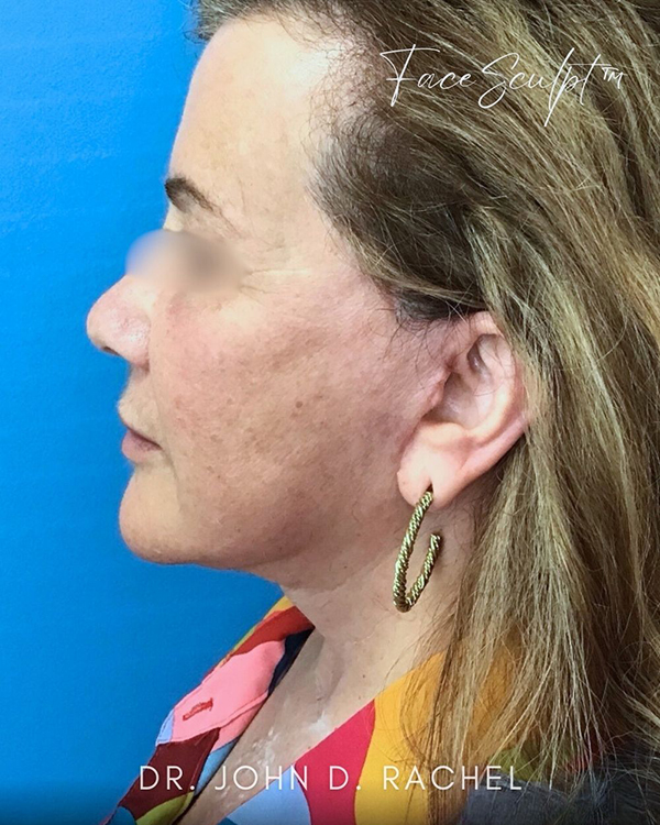 Side profile after mini facelift surgery