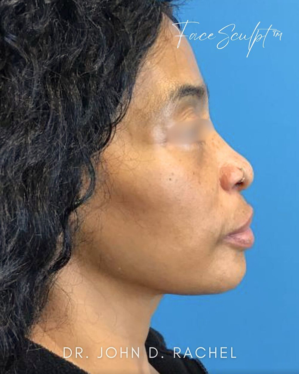 Neck Lift