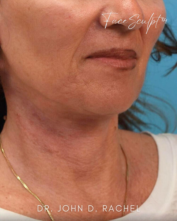 Neck Lift