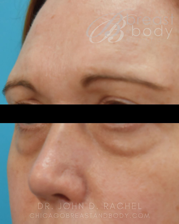 Front view before lower eyelid surgery