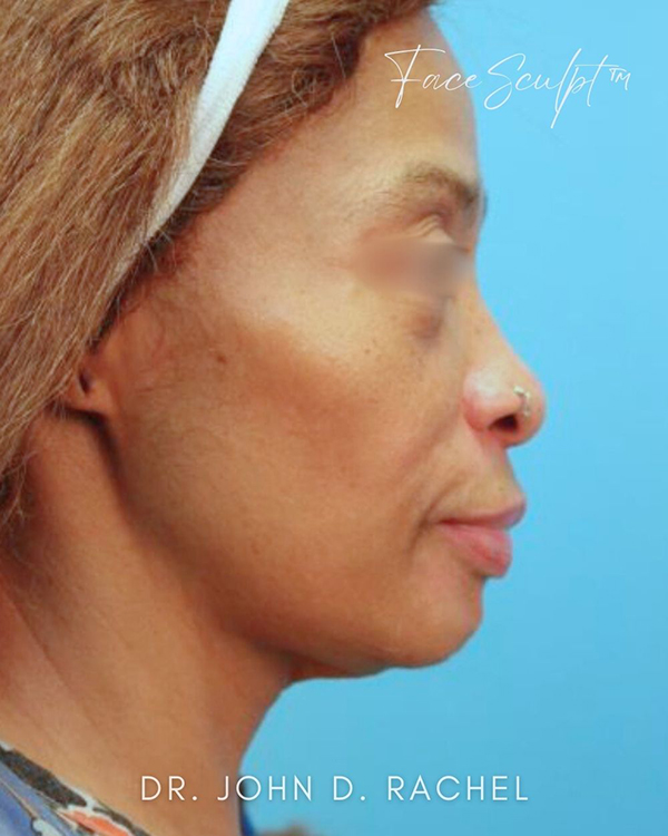Neck Lift