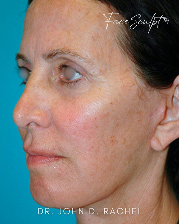 Side profile post-mini facelift with defined jawline