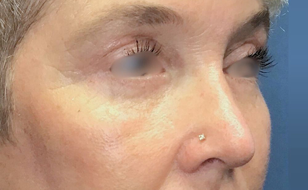 Side view of patient after upper eyelid surgery