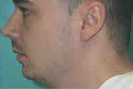 Chin Implants Before & After