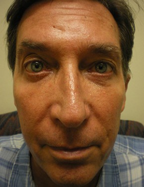 Functional Nasal Surgery Before & After