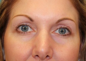 Eyelid Surgery Before & After