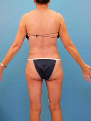 Total Body Liposuction Before & After