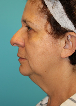 Facelift Before & After