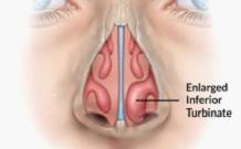 Enlarged Inferior Turbinate