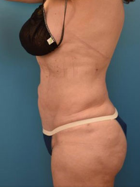 Liposuction abdomen and waist Before & After