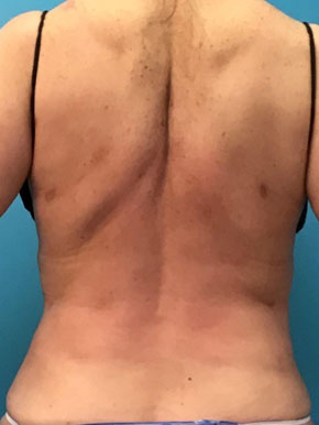 Liposuction waist and back Before & After