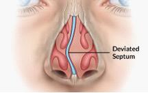 Deviated Septum