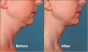 Kybella results