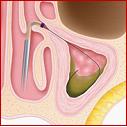 step-1-balloon-sinus-dilation